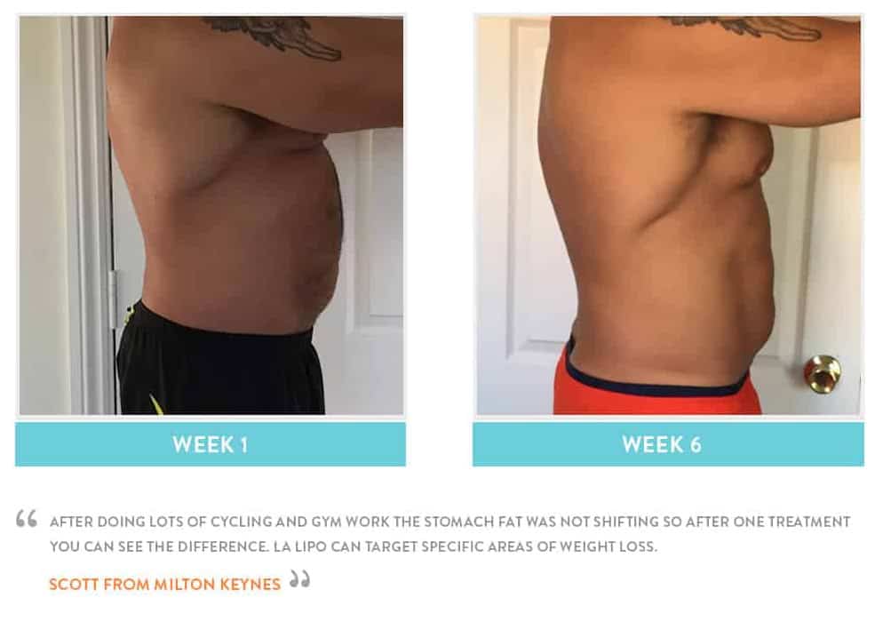 Before & After Stomach Fat Surbiton