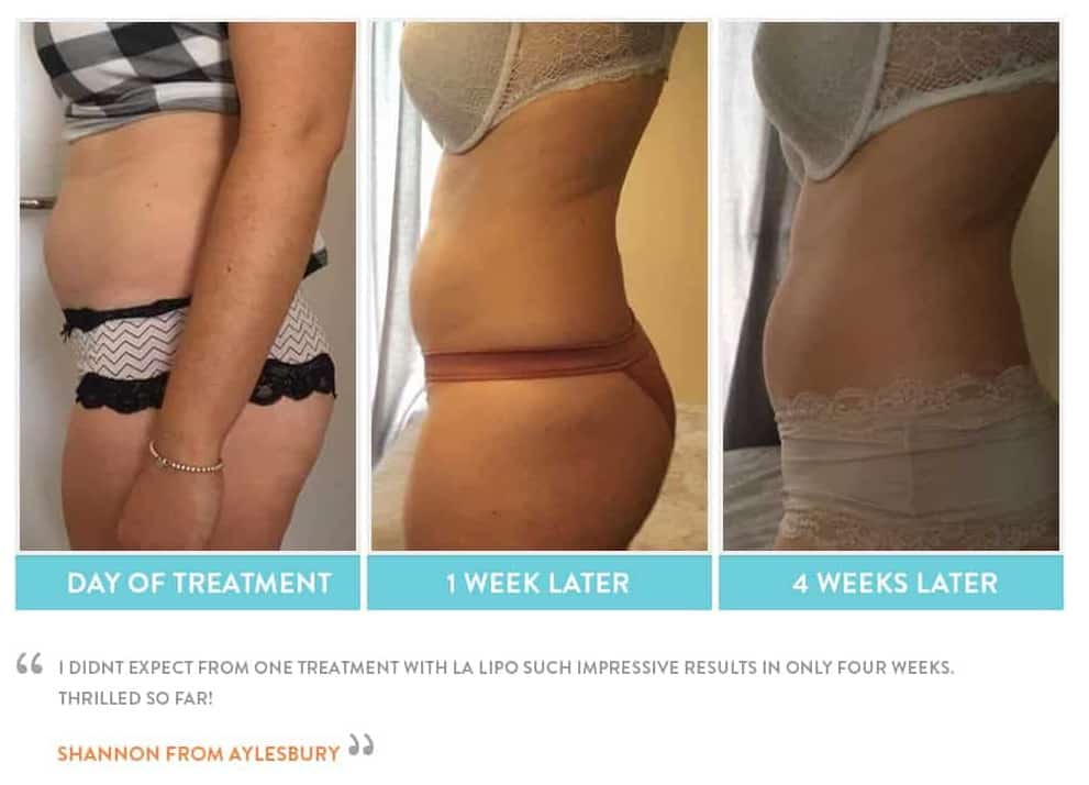 before, Cryolipolysis Surbiton