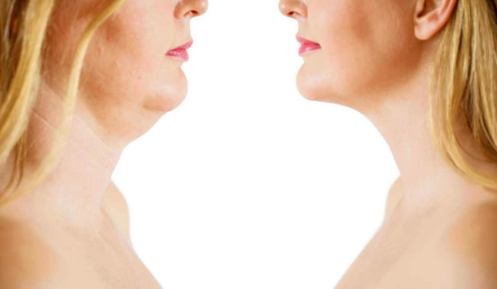 Double Chin treatment Surbiton before and after results