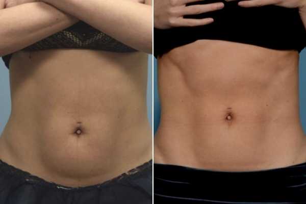 body sculpting FAQs Surbiton