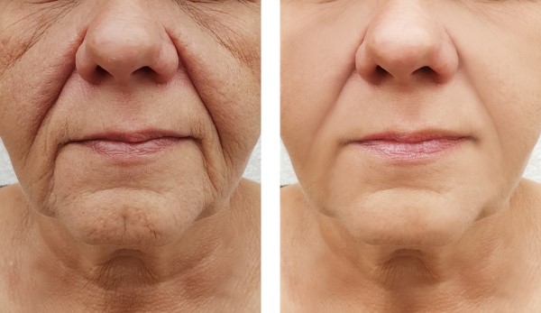 Learn more about Morpheus8 Treatment Surbiton today!