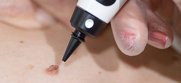 After Skin Tag Removal Surbiton