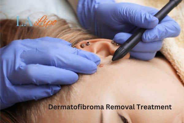 Dermatofibroma Removal Treatment Surbiton