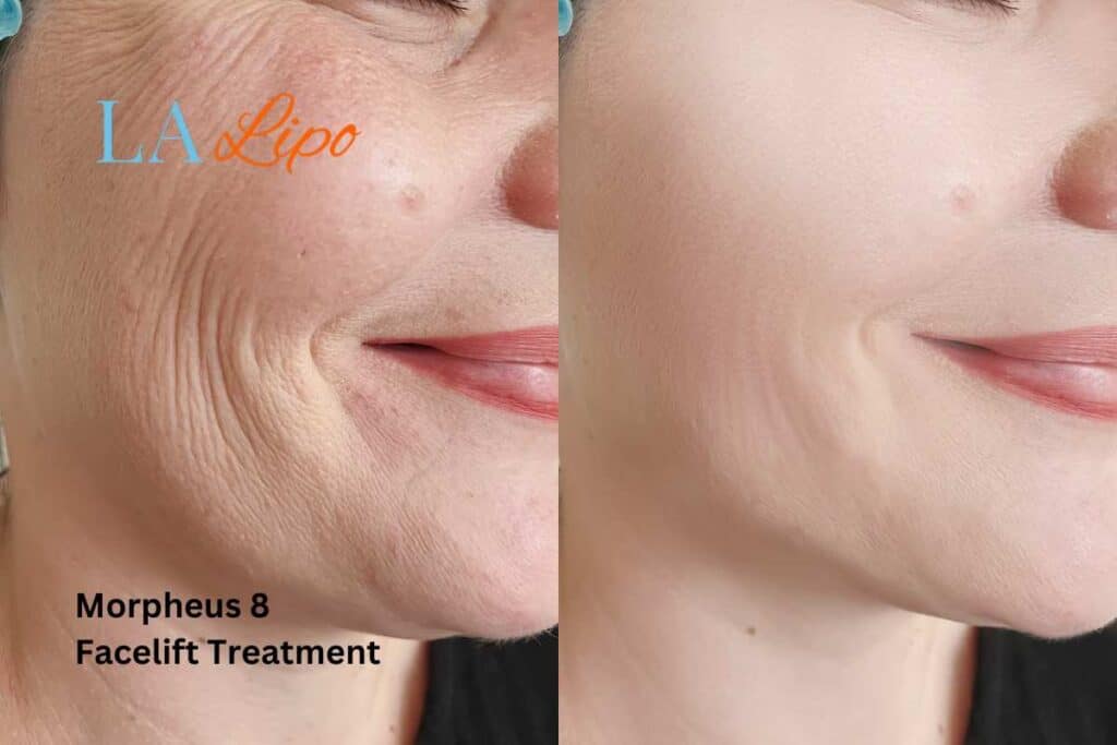 Morpheus8 Treatment Surbiton for flawless skin! Call us today!
