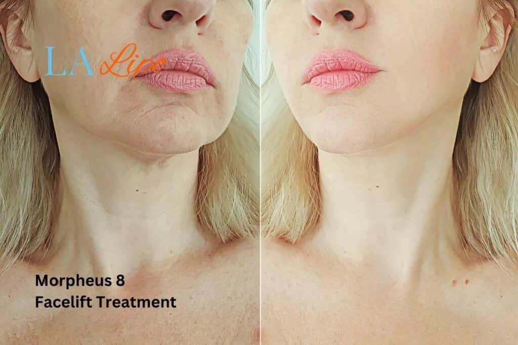Turn back time with Morpheus8 Treatment Surbiton