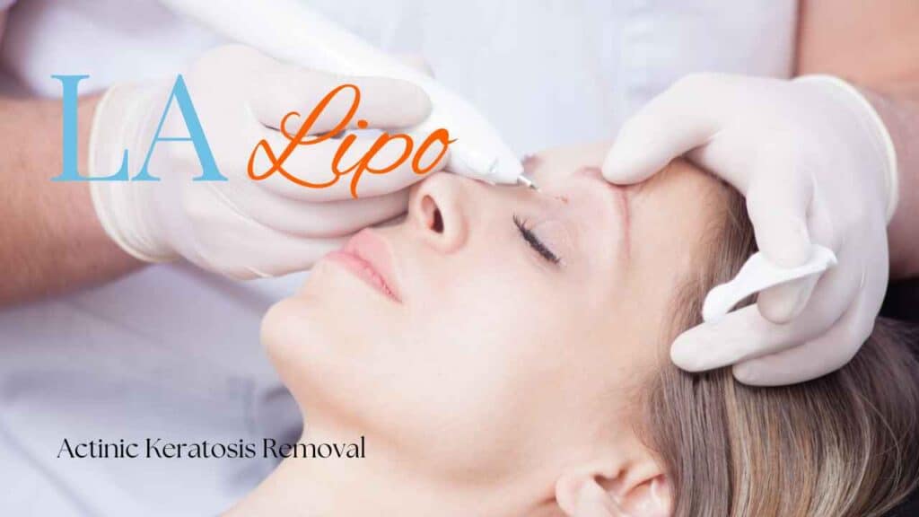 actinic keratosis removal Surbiton