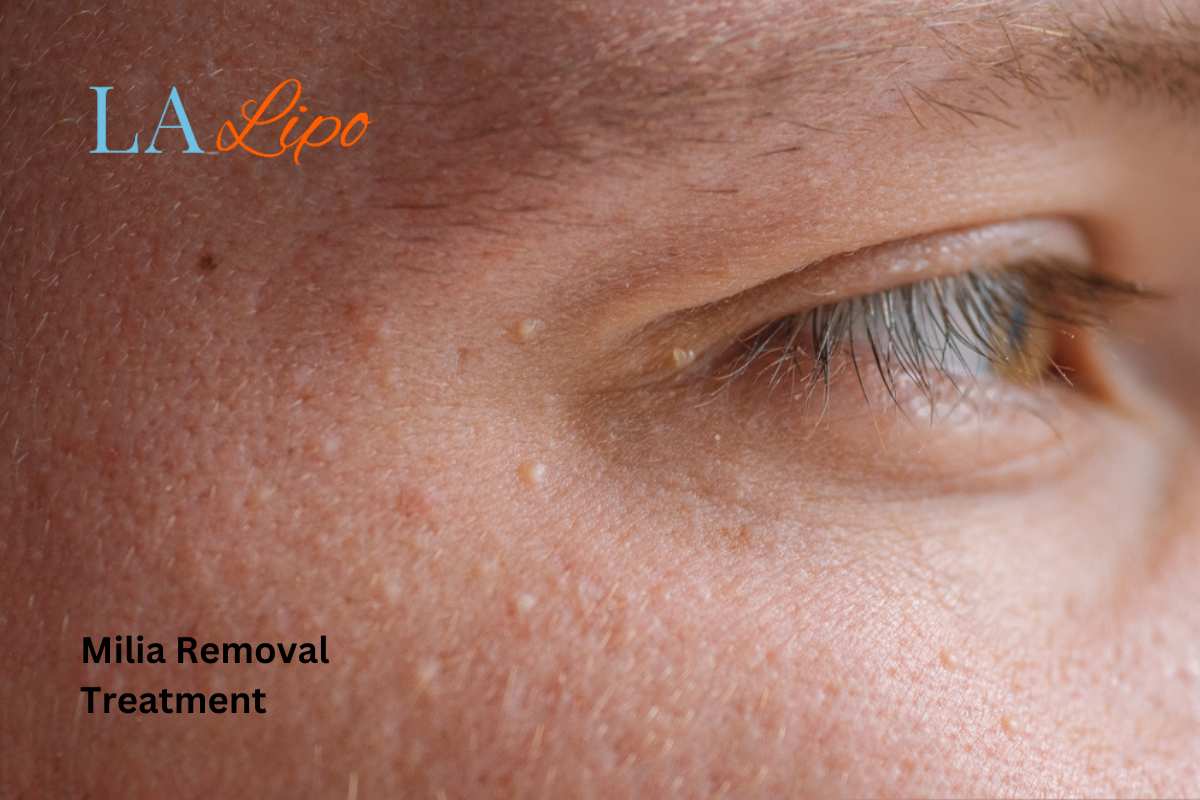 Cryopen Milia Removal: Is It the Easiest and Safest Option Surbiton?