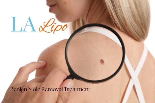 Woman having her inspection of blemish before mole removal Surbiton