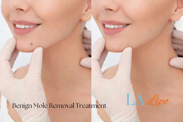 Before and after mole removal Surbiton treatment