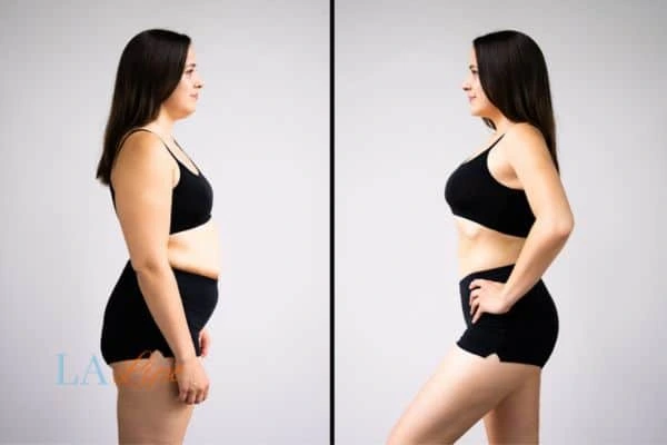 image of woman before and after results of LA-EMS Body Sculpting Surbiton to help treat Diastasis recti