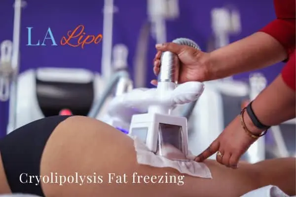 women getting fat freezing Surbiton