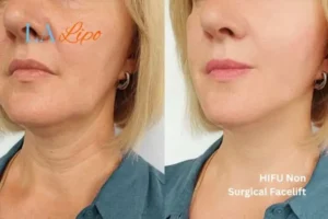 hi-fu for wrinkles Surbiton before and after results