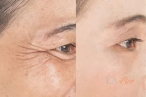 Before and after results of woman - HI-fu wrinkles reduction treatment Surbiton