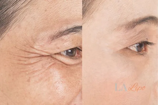 Before and after results of woman - HI-fu wrinkles reduction treatment Surbiton