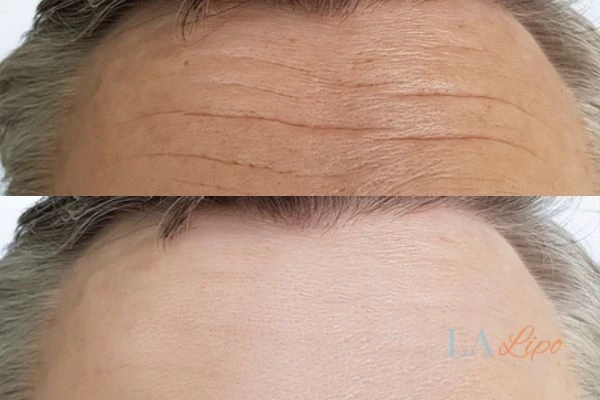 results of HIFU Surbiton on mans forehead to help reduce lines and wrinkles
