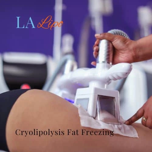 fat freezing - Cryolipolysis Surbiton
