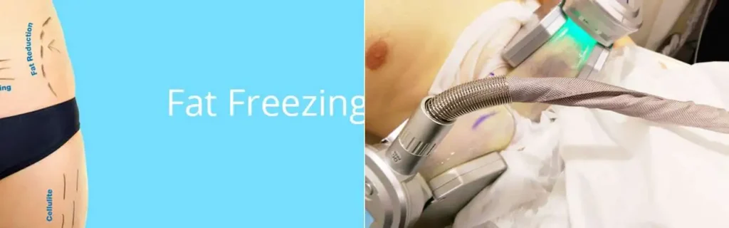 Fat freezing Surbiton on multiple areas of the body