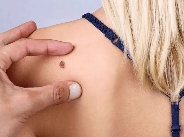 woman having mole removal Surbiton consultation before treatment.