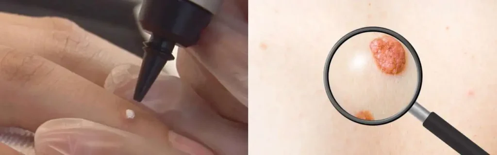 Cryopen for mole removal Surbiton - speak to our team today!