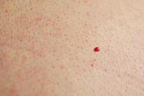 close up of a cherry angioma Surbiton