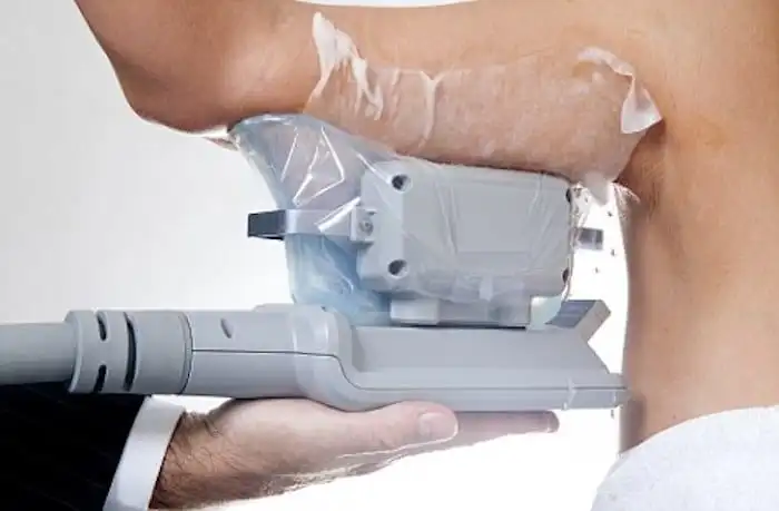 Picture of fat freezing Surbiton on the upper arms.
