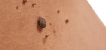 image of a skin tag Surbiton