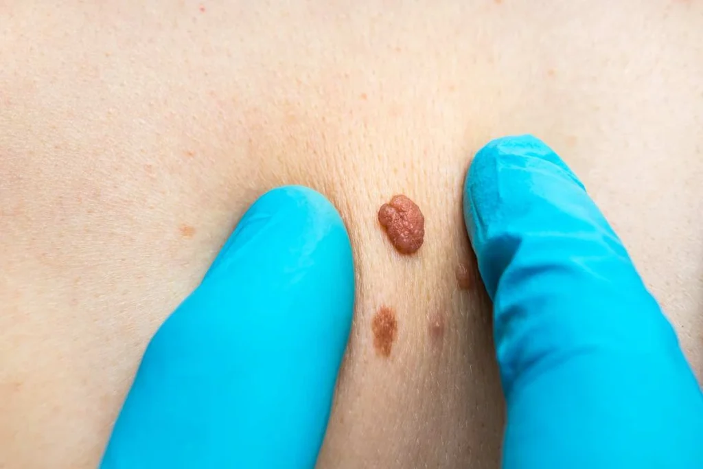 Consultant examining a skin tag Surbiton