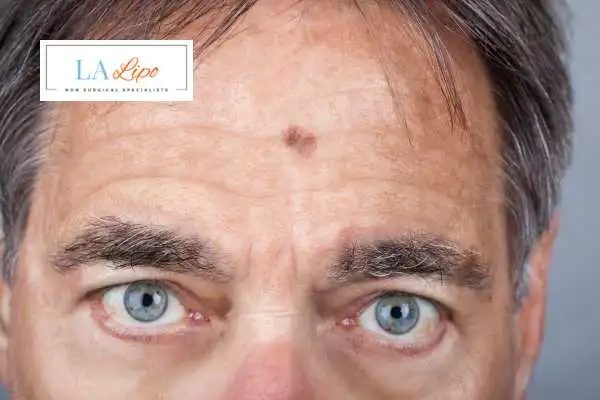 Solar Lentigo Removal Surbiton image of man with mark on his forehead