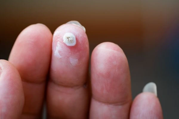 wart on person finger - cryotherapy to treat from LA LIPO Surbiton