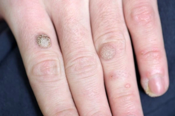 photo of warts on person hand - see wart removal Surbiton from LA LIPO