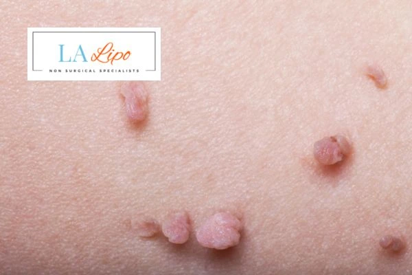 Does cryopen skin tag removal Surbiton hurt? Find out now call our team today!