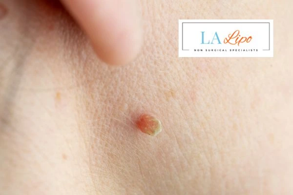 Book skin tag removal Surbiton today speak to our team now!