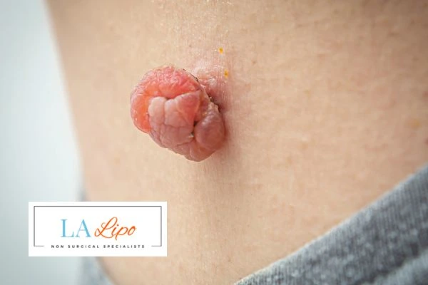 Interested in skin tag removal Surbiton? Concerned about the pain? Find out more today!