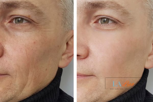 See the amazing results of Morpheus8 Treatment Surbiton!