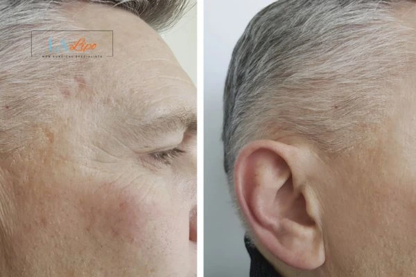 Mens Before & After Morpheus 8 Results Surbiton