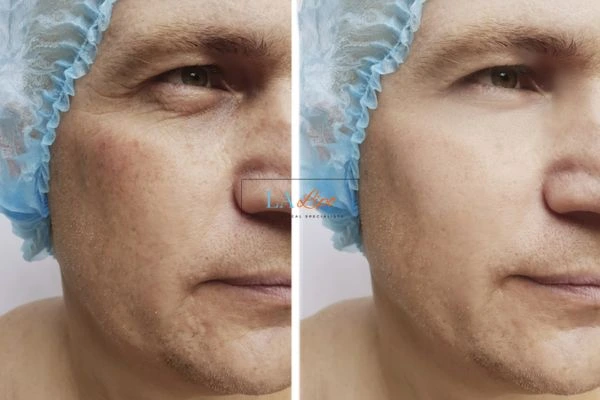Before and after Morpheus 8 Results Surbiton