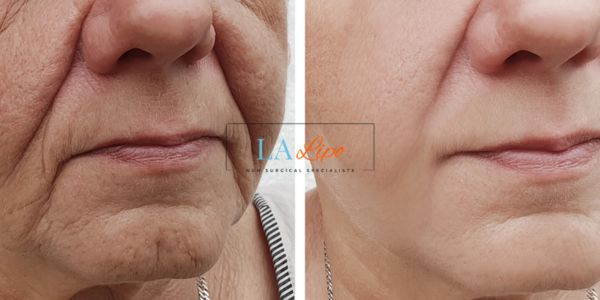 Older lady deeper wrinkle reduction - LA LIPO Morpheus 8 Results Surbiton