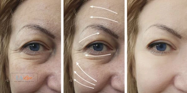 Amazing eye lift Morpheus 8 results Surbiton