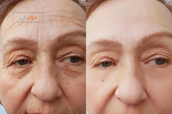 The powerful benefits of Morpheus8 Treatment Surbiton - Call Our team today!