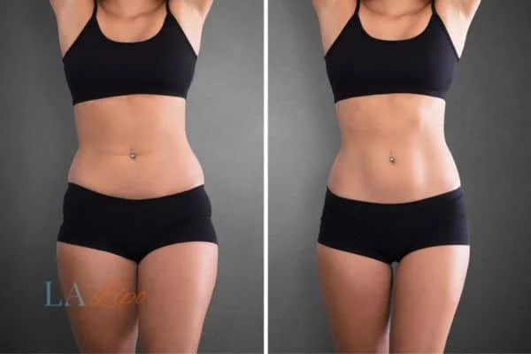 before and after results of non-surgical treatment to help a woman's body image and mental health Surbiton