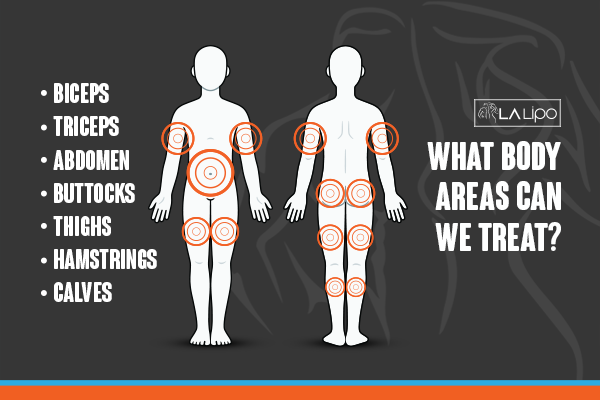 Diagram to show areas you can have LA-EMS Body Sculpting Treatment Surbiton