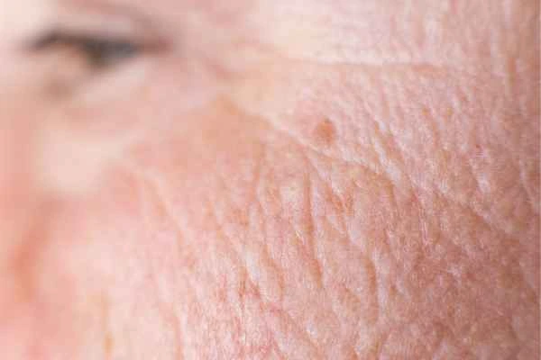 close up picture of a woman's face showing an age spot Surbiton