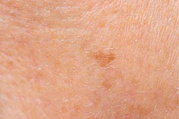 close up picture of age spots Surbiton