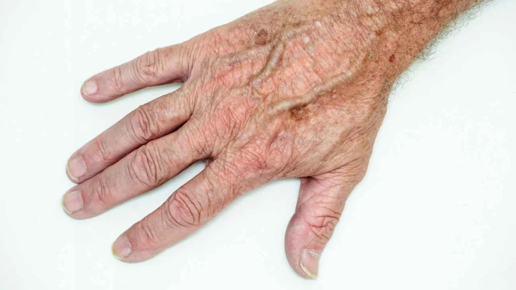 Male hand showing age spot Surbiton