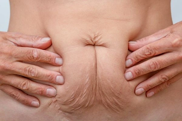 Image of a woman's stomach with loose skin - example of skin tightening Surbiton options