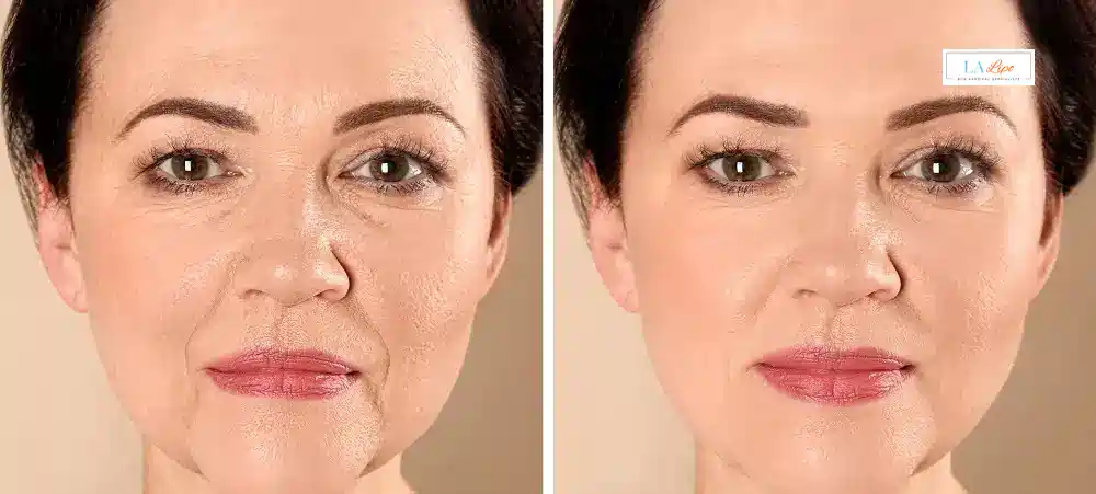 How Long Does It Take to See Results and How Long Do They Last Surbiton?